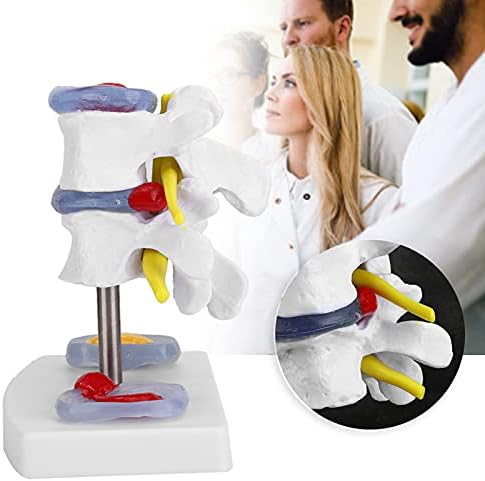 Wene Human Spine Model, Професионален живописен лумбален модел јасно студира со 2 заболени интервертебрални дискови за училиште