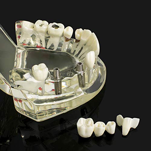 Деншин Стандарден модел на заби за заби на заби за заби за заби на заби Реставрација со имплантација за демонстрација