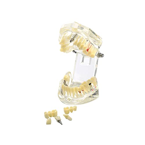 СНАВОП Стоматолошки Имплант Модел Болест Транспарентен Модел На Заби Патолошки Модел На Заб со Отстранливи Заби За Стоматолошка Студија