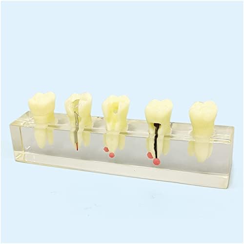 KH66ZKY модел на стоматолошки кариес, модел на стоматолошки заби, симулиран модел за третман на орален корен за канали за лекар-пациент
