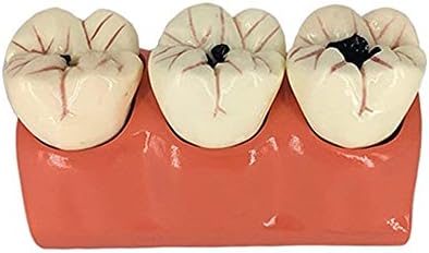 Модел на анатомија на кинофу, модел на заби на заби модел на едукација на пациенти Кариес Расклопување на модел на заби, кариес