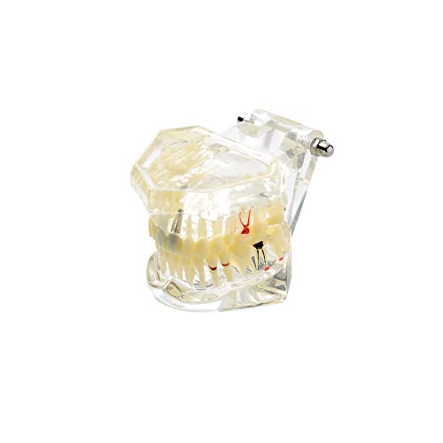 Транспарентен модел на заби на заболување, модел на настава за забни импланти со отстранливи заби